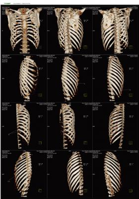 醫(yī)用ct膠片-肋骨