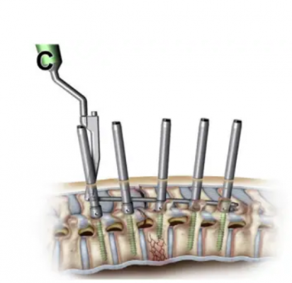 脊柱固定系統(tǒng)-椎弓根螺釘冠亞直銷價(jià)