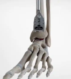 踝關(guān)節(jié)假體正天價(jià)格范圍