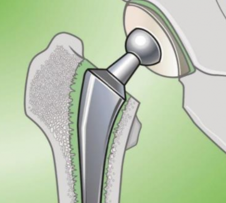 關(guān)節(jié)骨水泥邦塞采購(gòu)