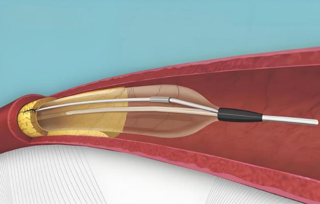 外周刻痕球囊擴張導(dǎo)管 廠家