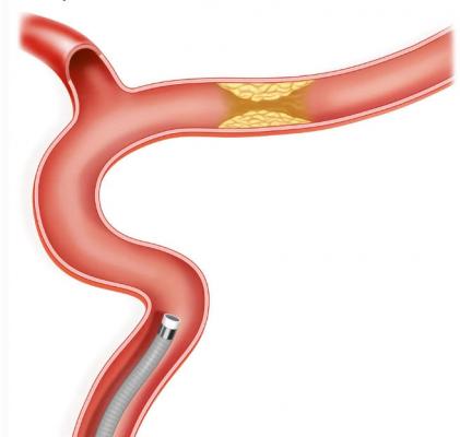 輸送型球囊擴張導管 廠家