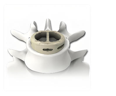 椎間融合器 供應(yīng)商