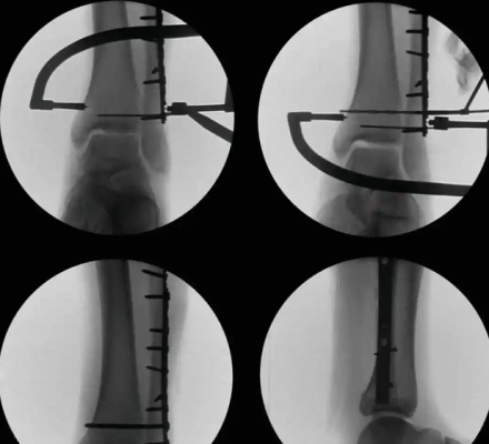 強生 下脛腓聯(lián)合固定系統(tǒng) 代理